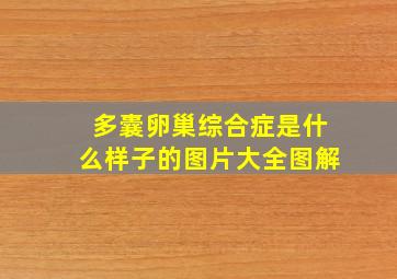 多囊卵巢综合症是什么样子的图片大全图解