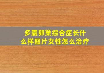 多囊卵巢综合症长什么样图片女性怎么治疗