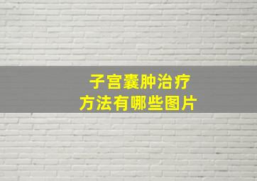 子宫囊肿治疗方法有哪些图片