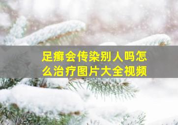 足癣会传染别人吗怎么治疗图片大全视频