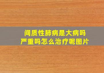 间质性肺病是大病吗严重吗怎么治疗呢图片