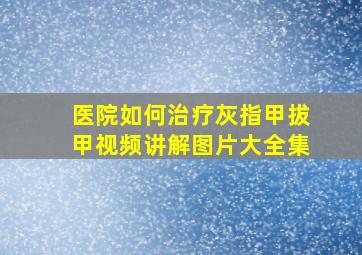 医院如何治疗灰指甲拔甲视频讲解图片大全集