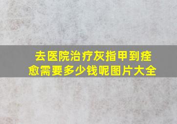 去医院治疗灰指甲到痊愈需要多少钱呢图片大全