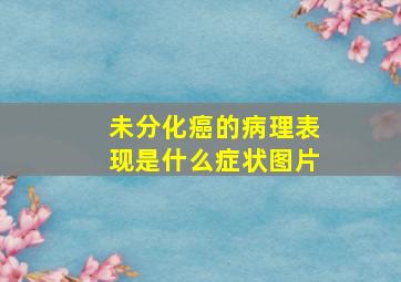 未分化癌的病理表现是什么症状图片