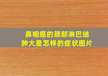 鼻咽癌的颈部淋巴结肿大是怎样的症状图片