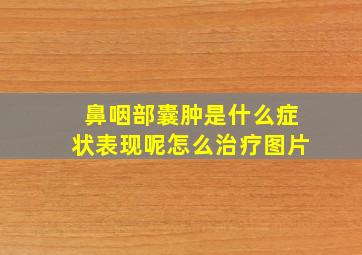 鼻咽部囊肿是什么症状表现呢怎么治疗图片